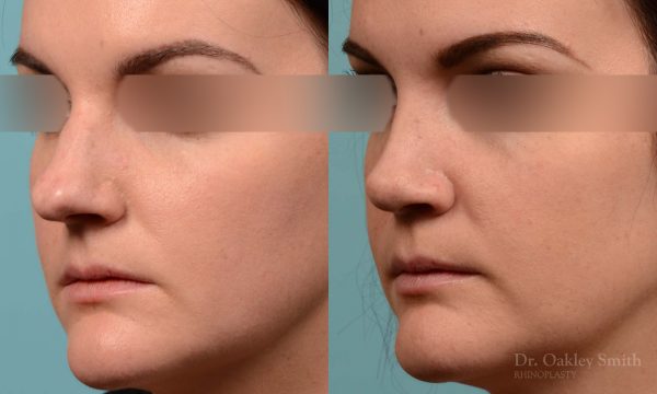 Hump Reduction, Rhinoplasty - Rhinoplasty Before and After Case 252