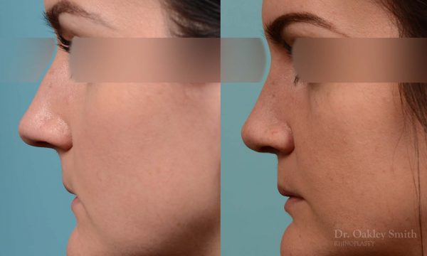 Rhinoplasty hump removal