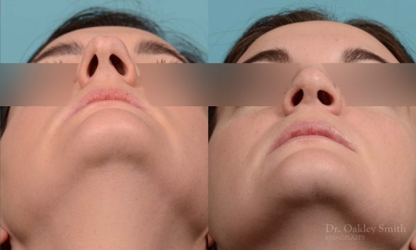 Rhinoplasty hump removal