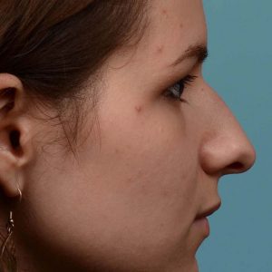 Rhinoplasty hump reduction