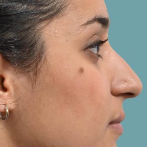 Rhinoplasty hump reduction
