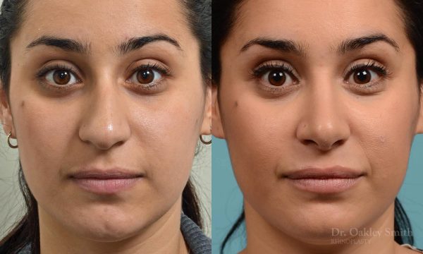 Rhinoplasty hump reduction