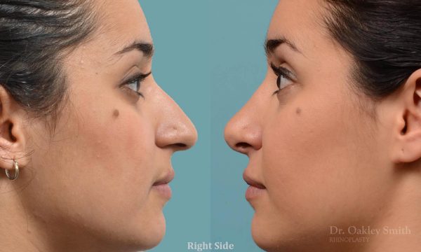 Rhinoplasty hump reduction