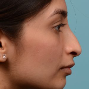 rhinoplasty hump reduction