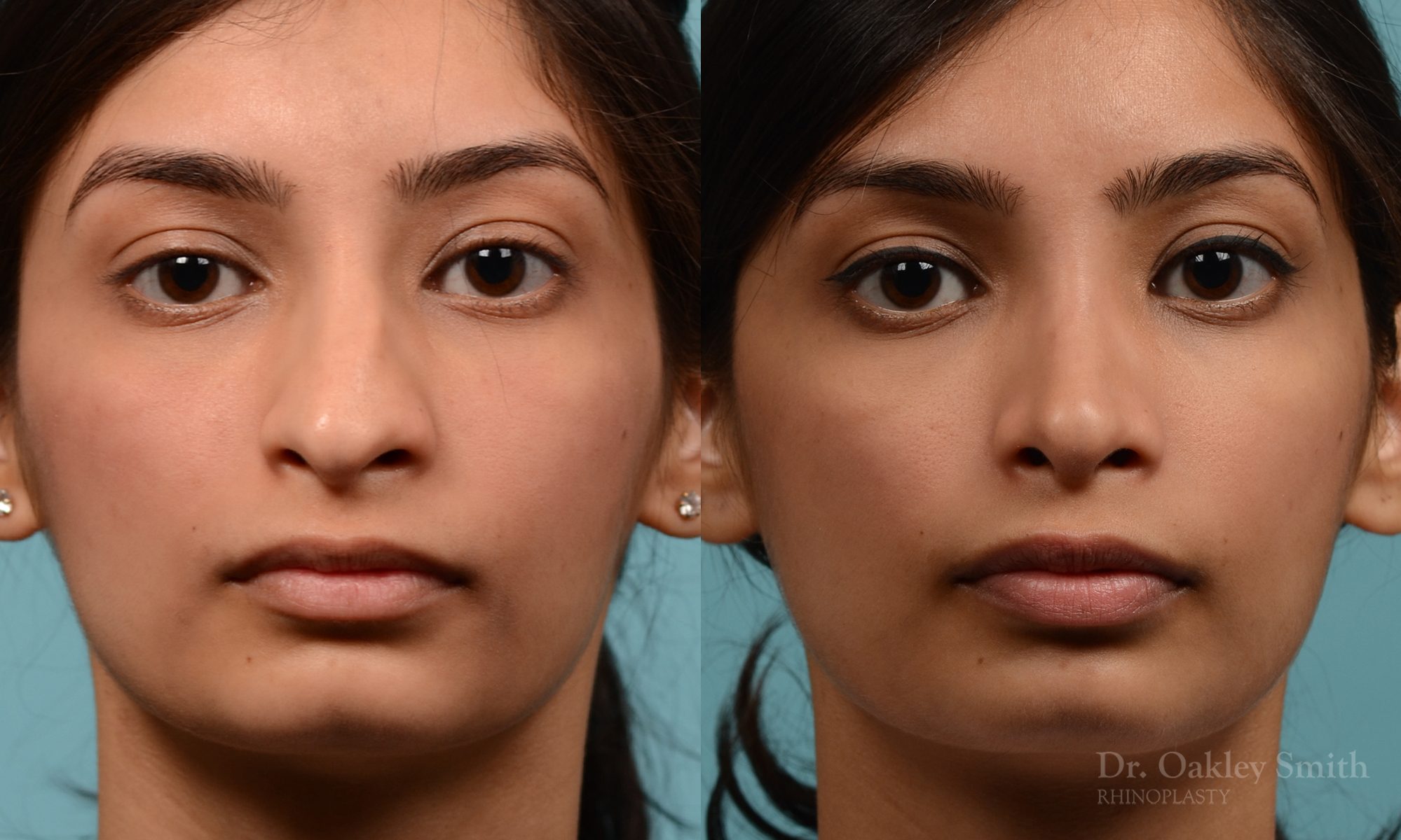 hump reductioon rhinoplasty surgery