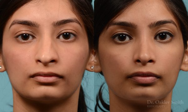 hump reductioon rhinoplasty surgery