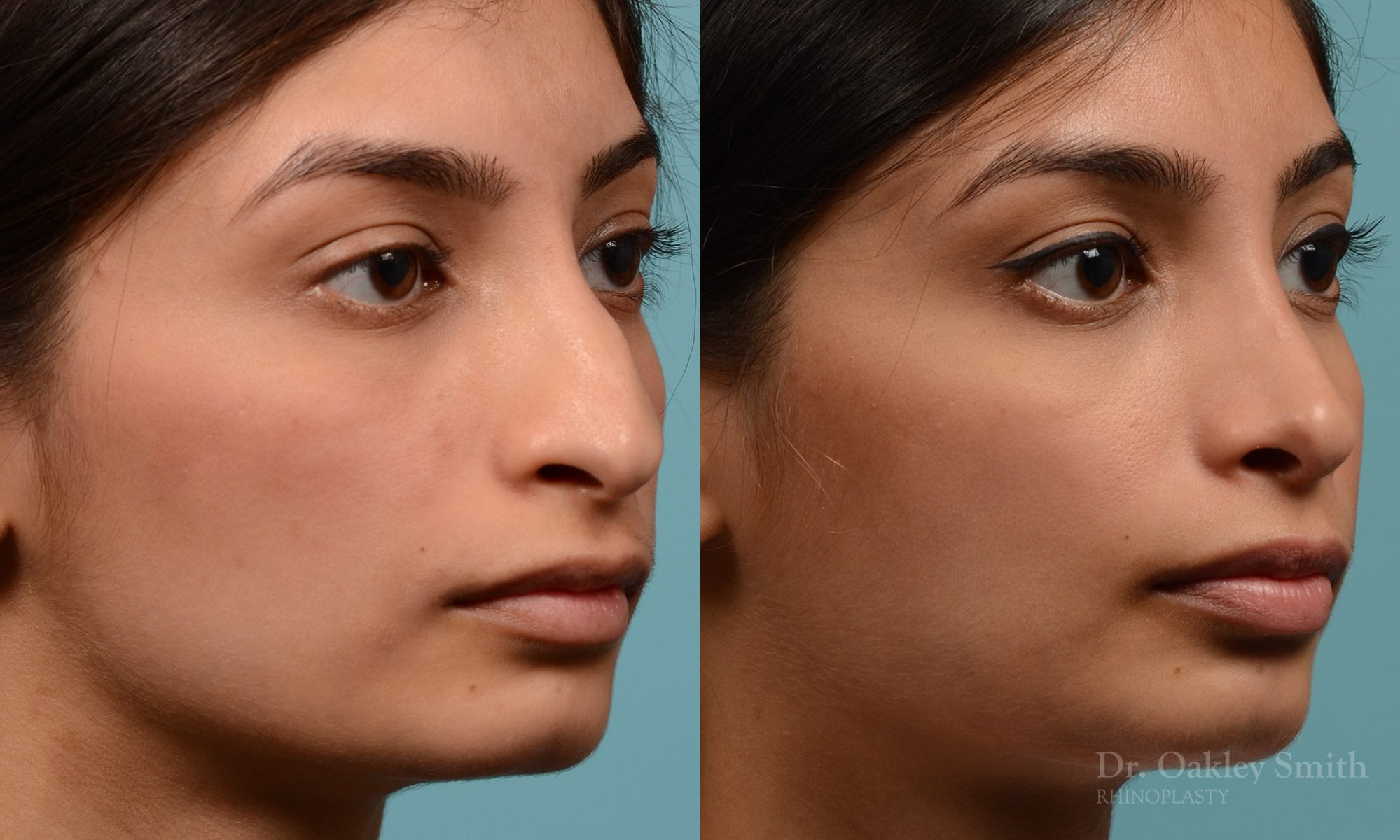 hump reductioon rhinoplasty surgery