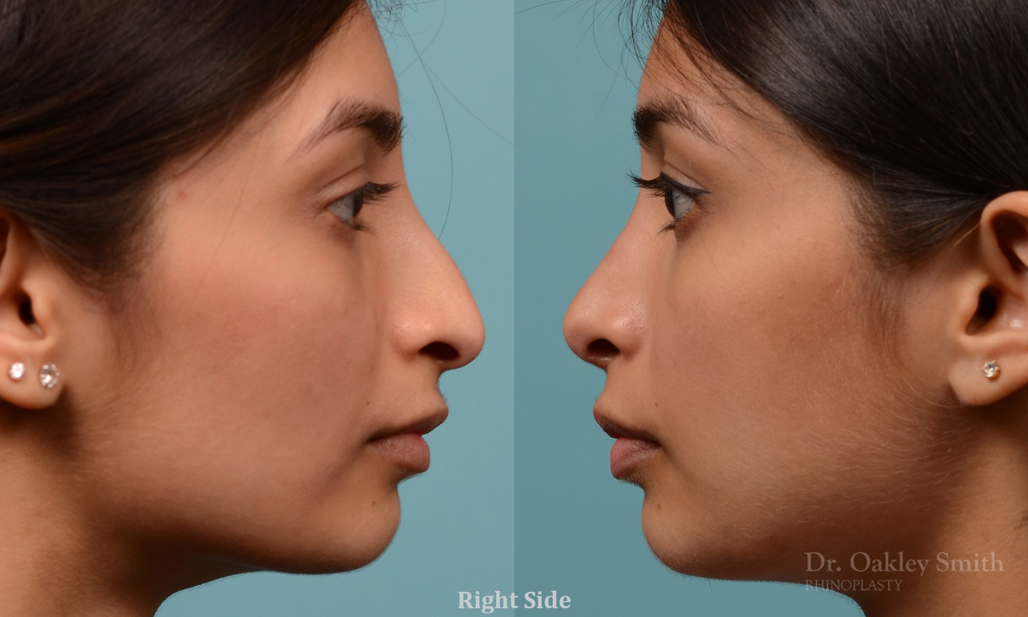 hump reductioon rhinoplasty surgery