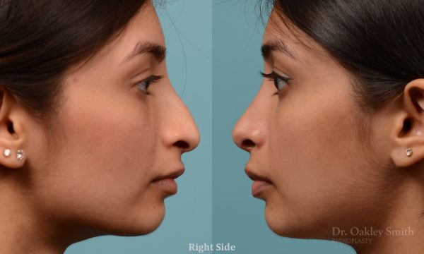 hump reductioon rhinoplasty surgery