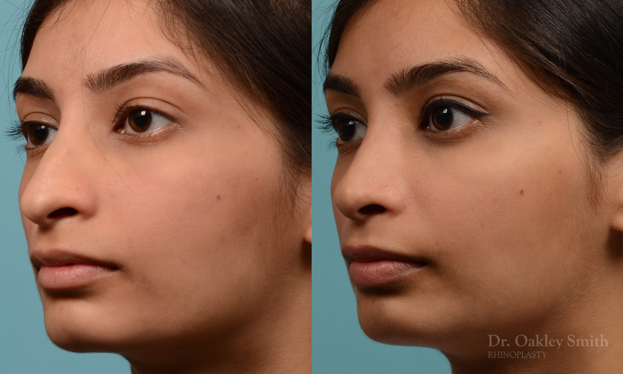 hump reductioon rhinoplasty surgery
