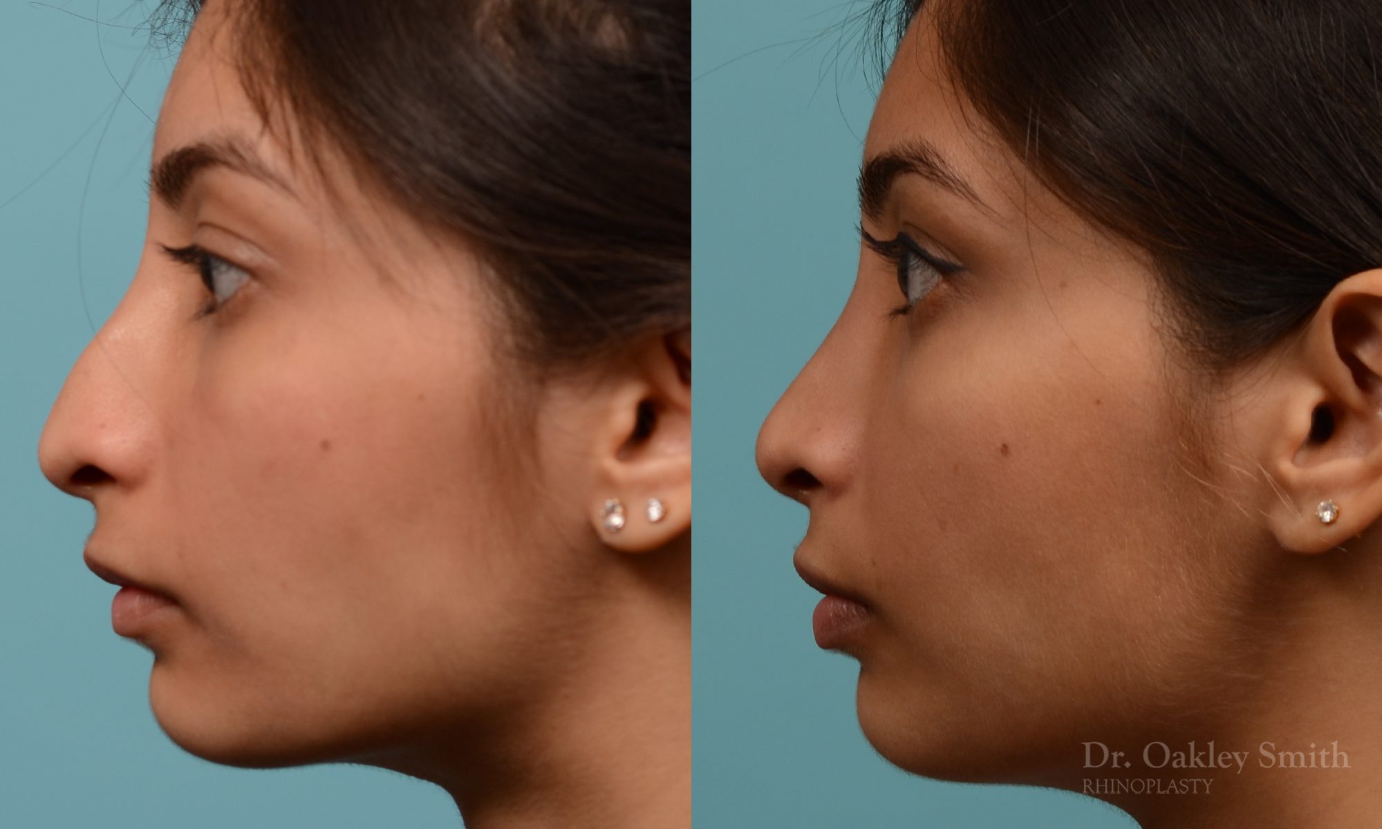 hump reductioon rhinoplasty surgery