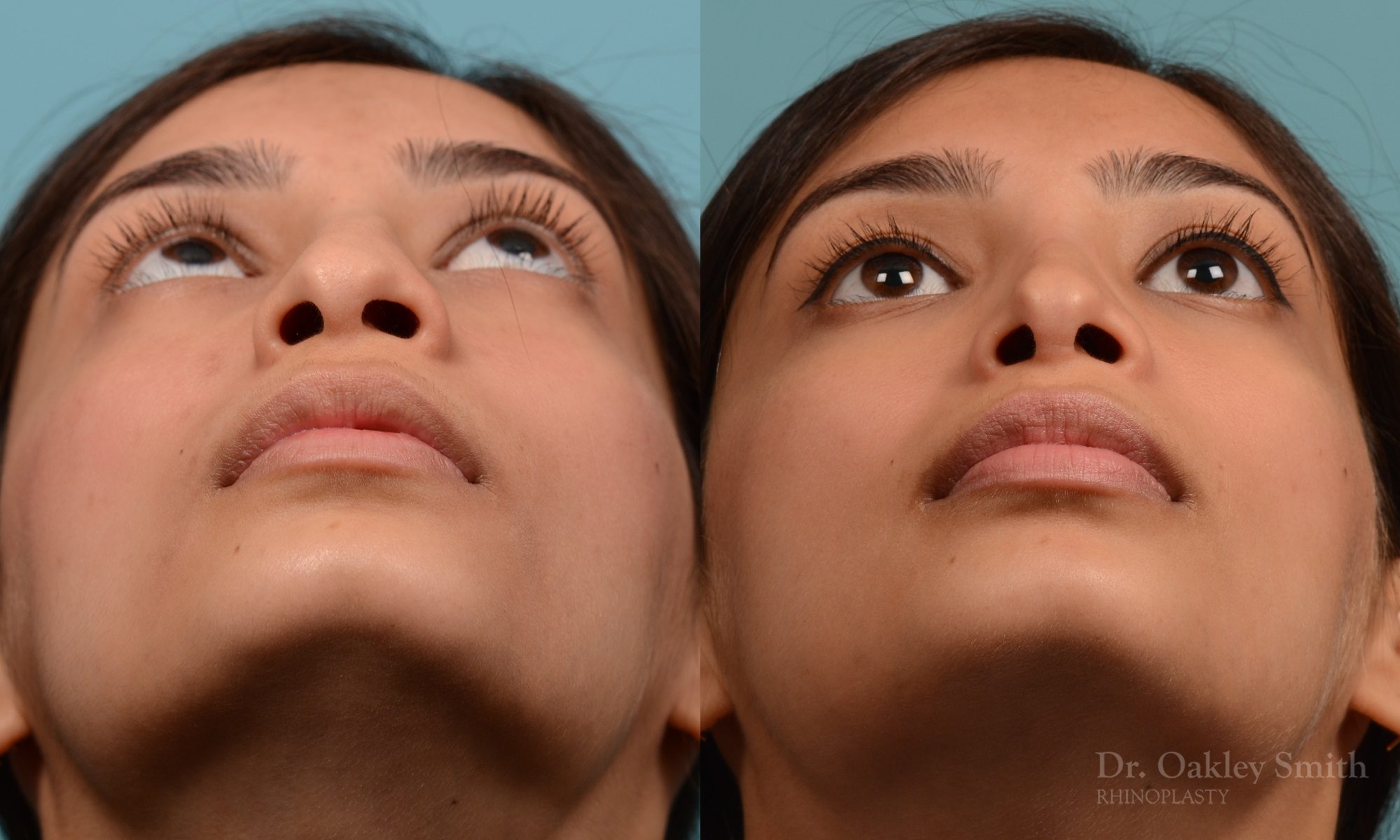 hump reductioon rhinoplasty surgery
