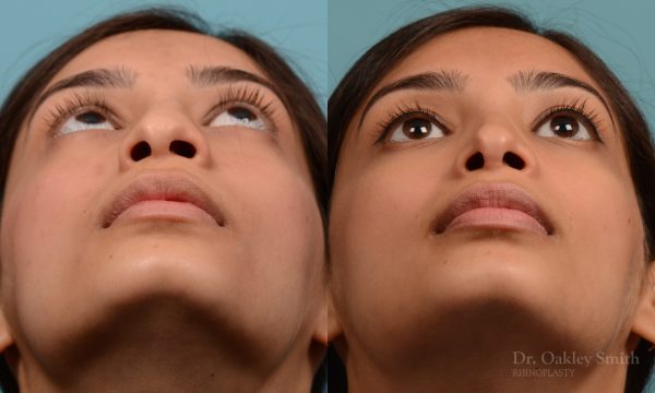 hump reductioon rhinoplasty surgery