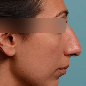 Rhinoplasty Hump reduction