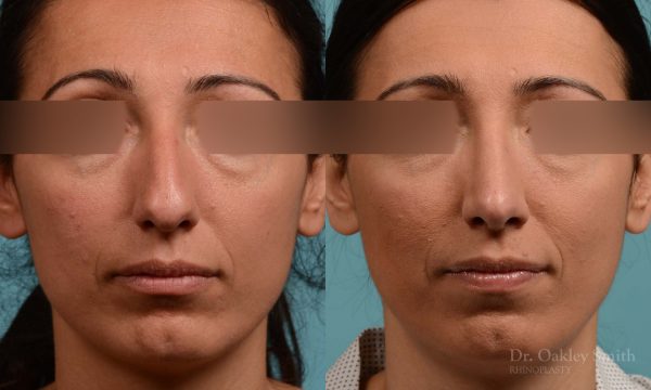 Hump reduction rhinoplasty to create a more feminine nose
