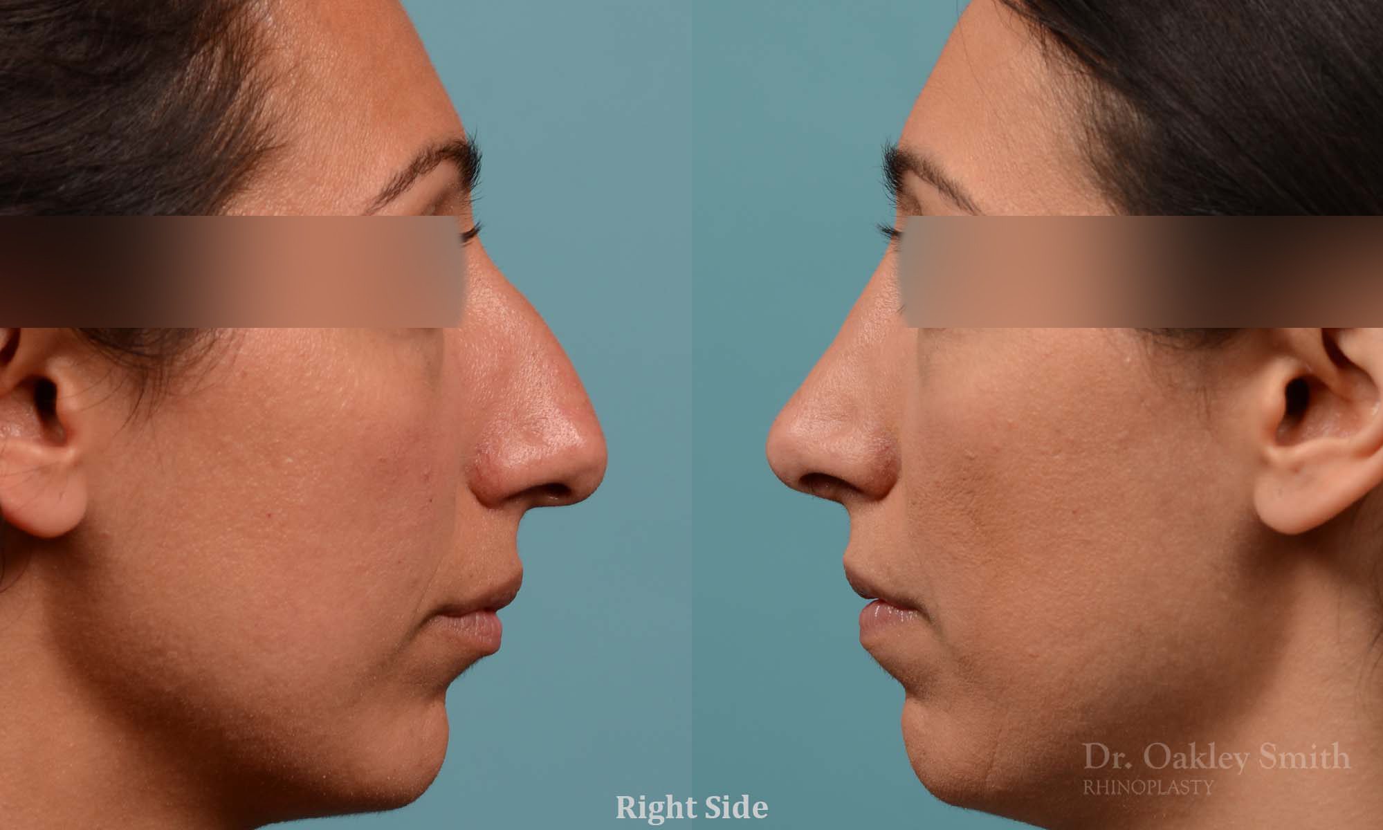 Hump reduction rhinoplasty to create a more feminine nose