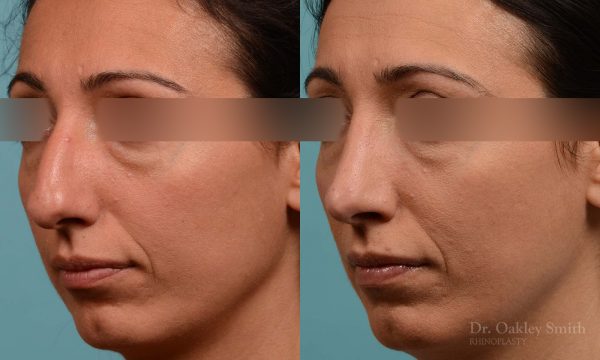 Hump reduction rhinoplasty to create a more feminine nose