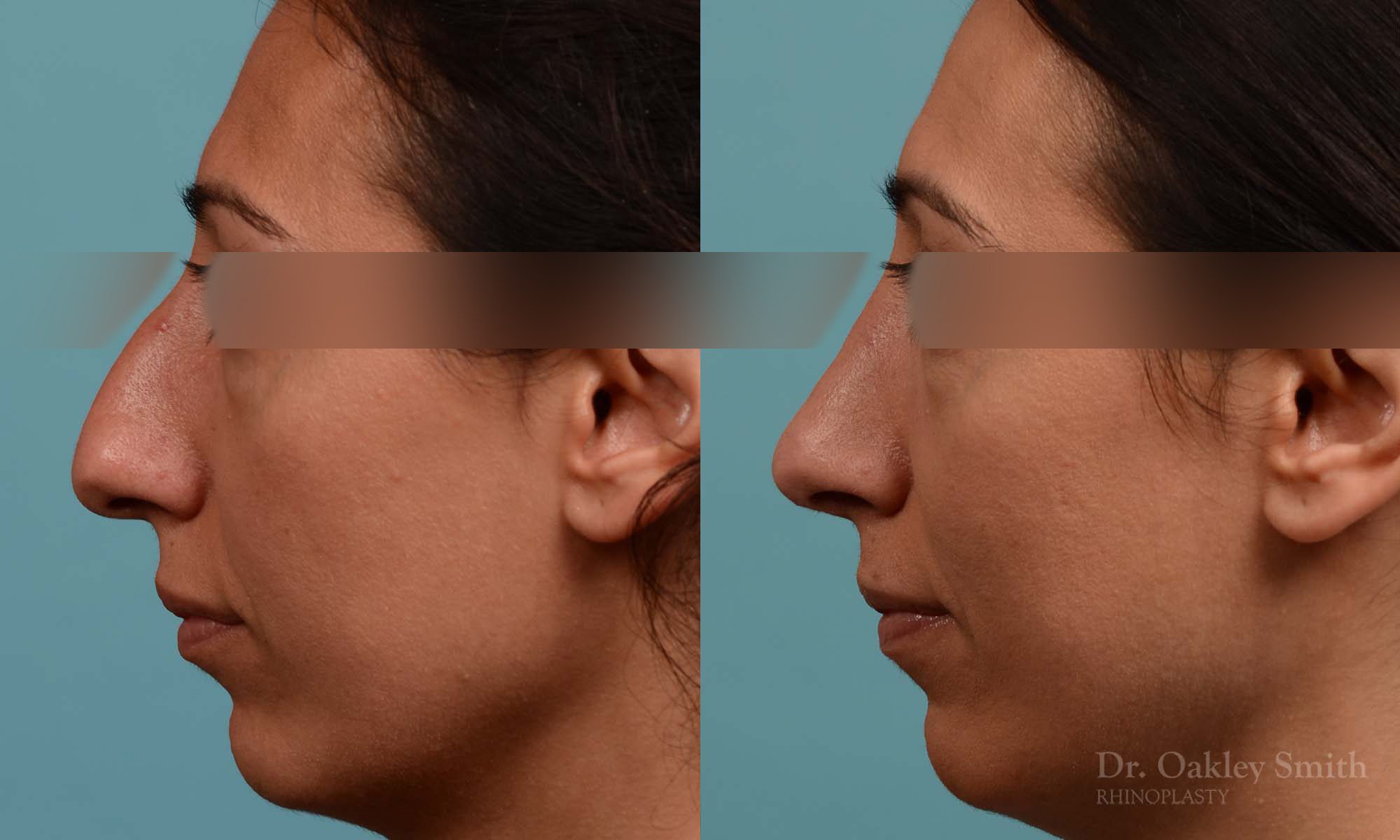 Hump reduction rhinoplasty to create a more feminine nose