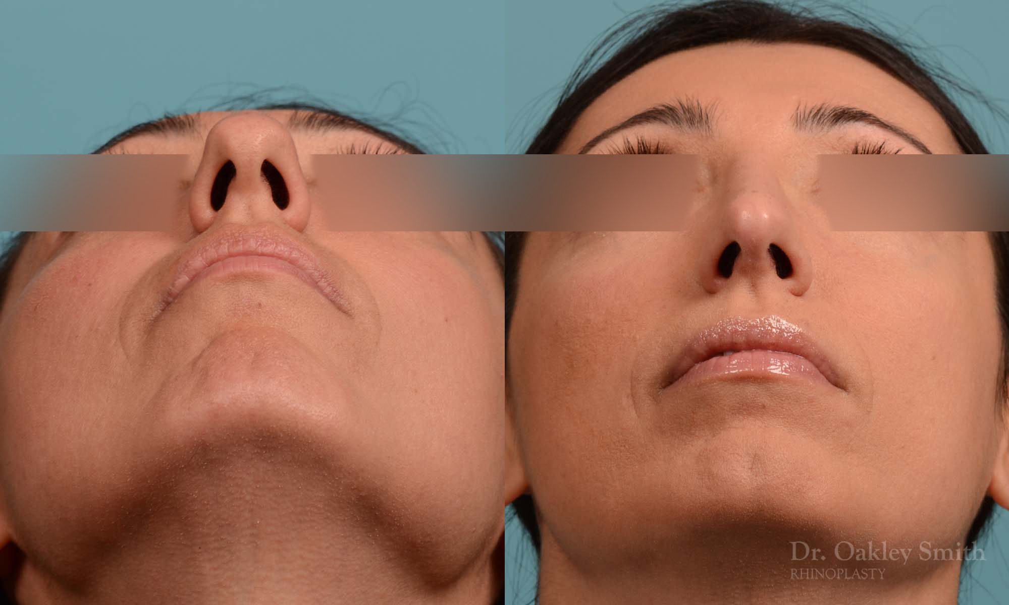 Hump reduction rhinoplasty to create a more feminine nose