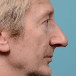 Male rhinoplasty hump redution