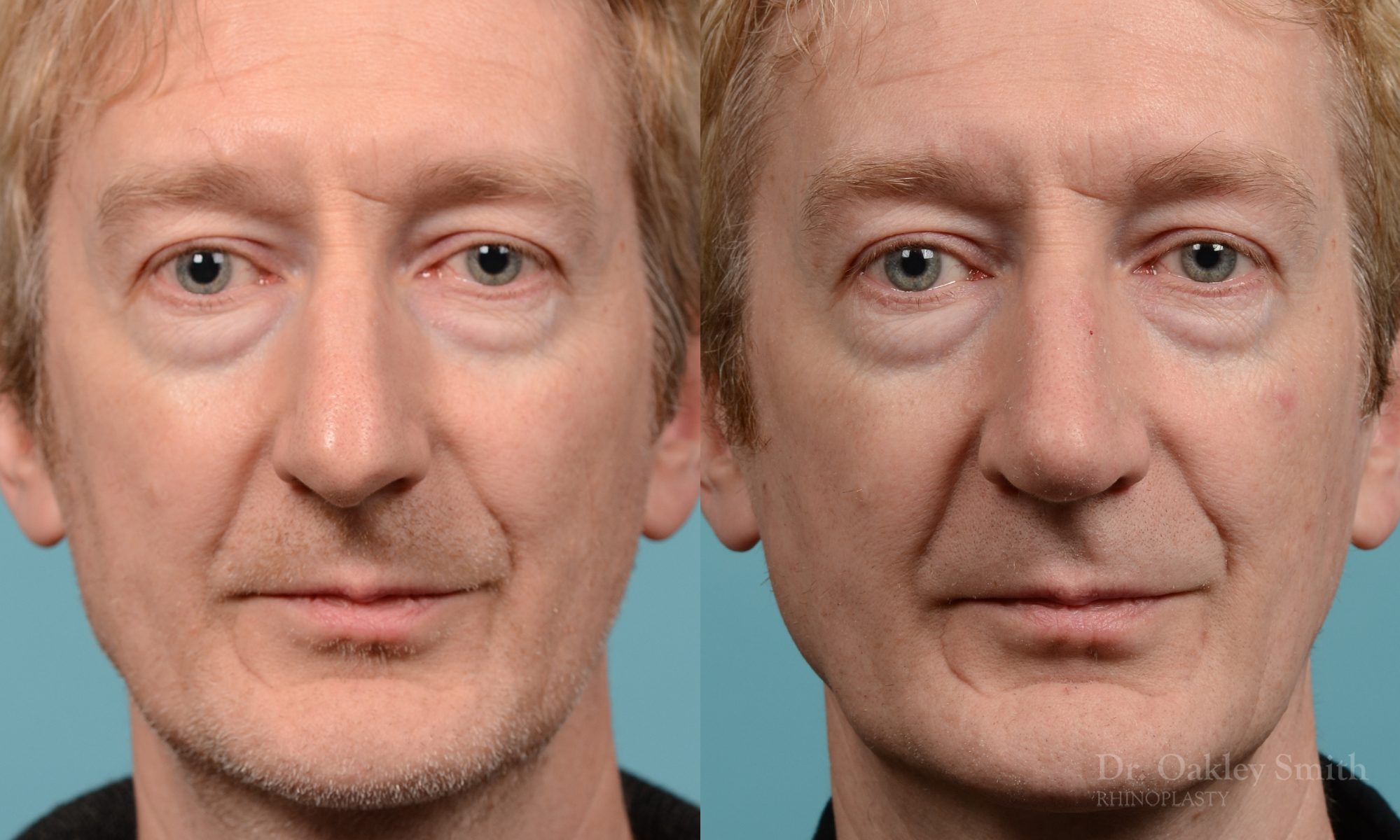 Male rhinoplasty hump redution