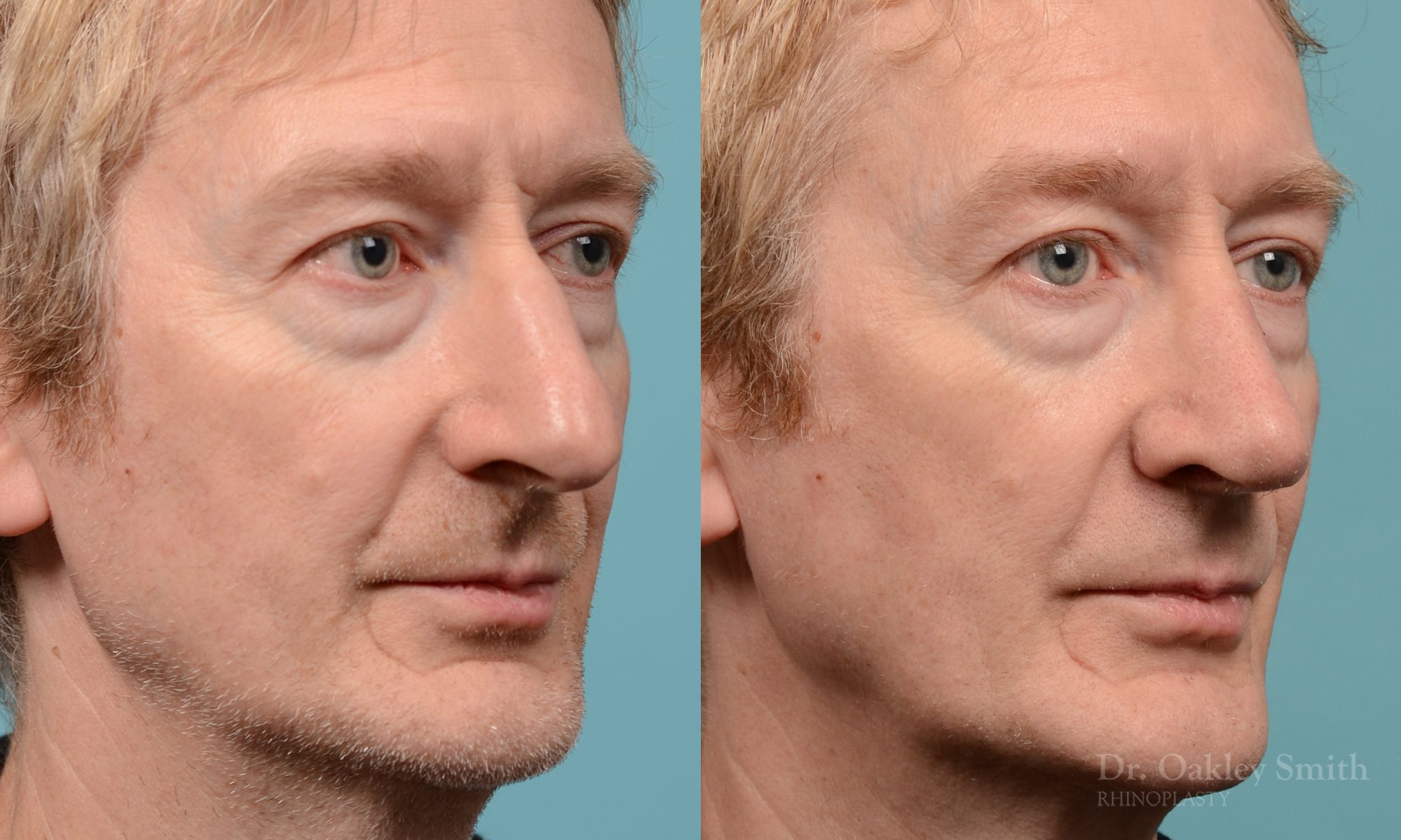 Male rhinoplasty hump redution