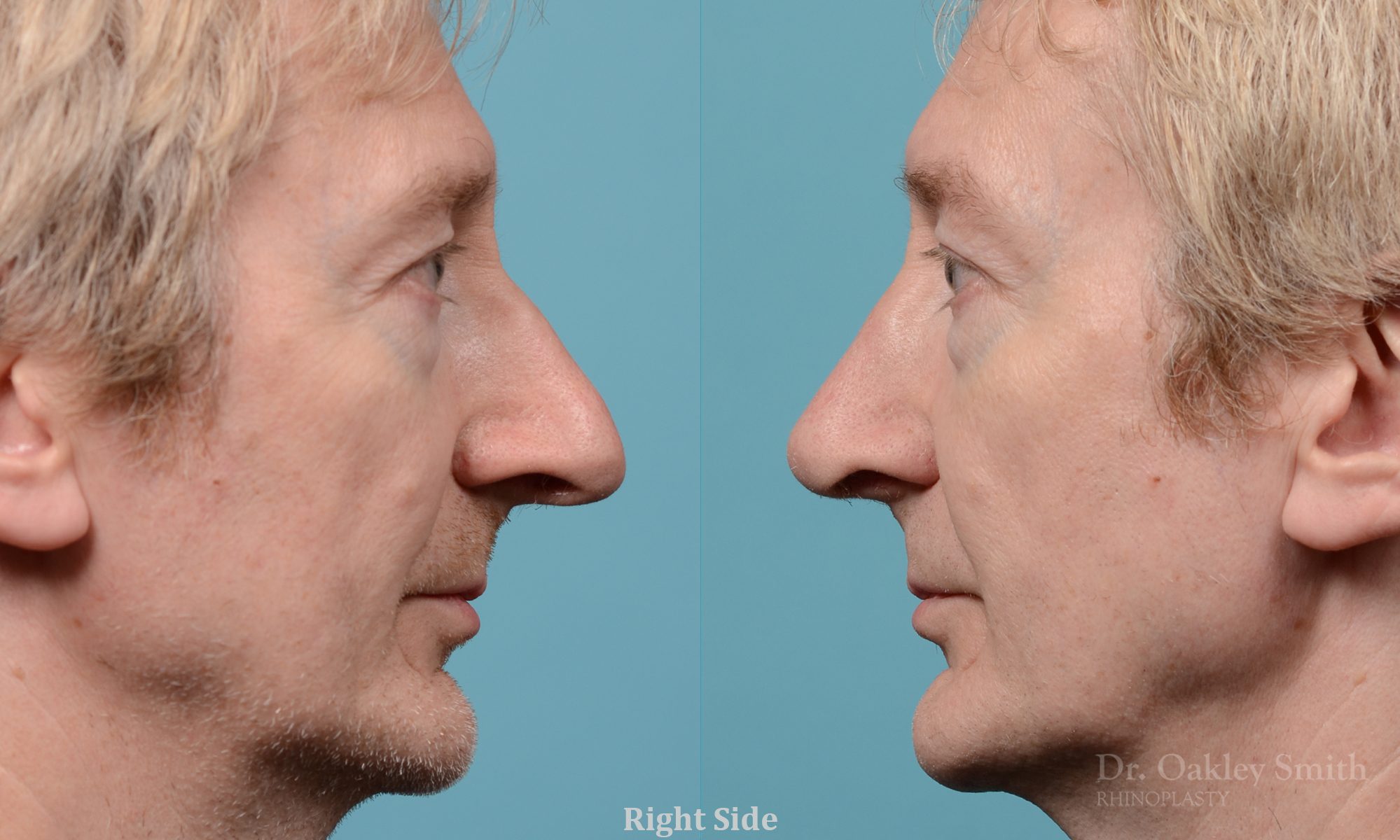 Male rhinoplasty hump redution