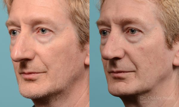 Male rhinoplasty hump redution