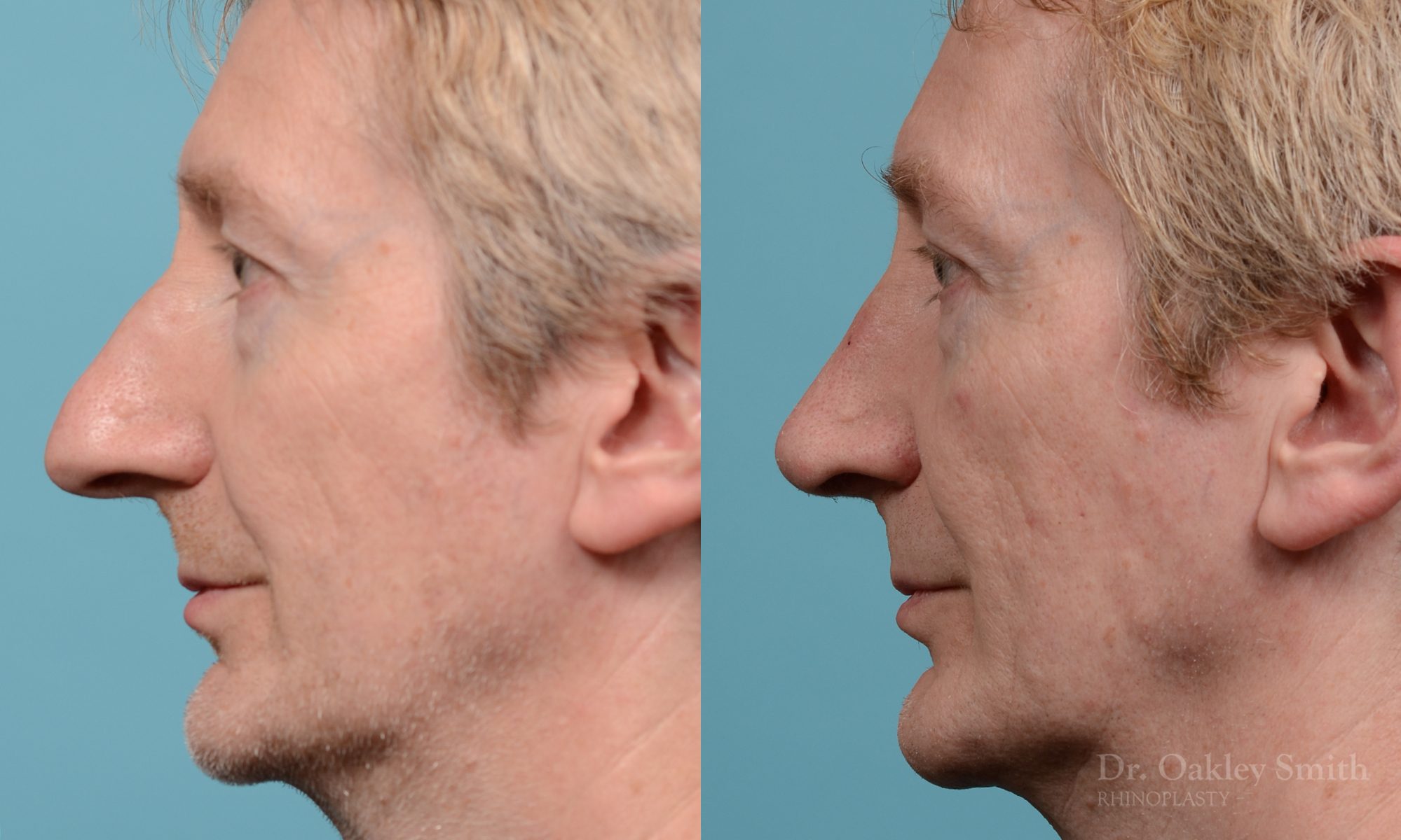 Male rhinoplasty hump redution