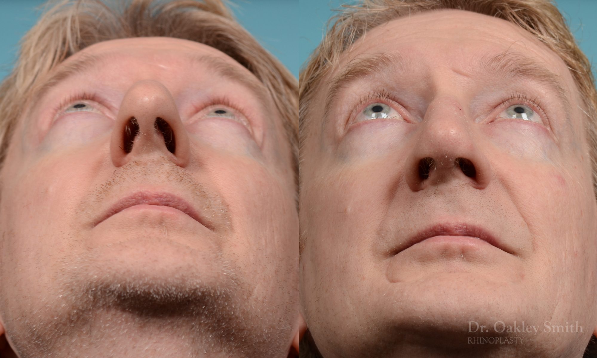 Male rhinoplasty hump redution