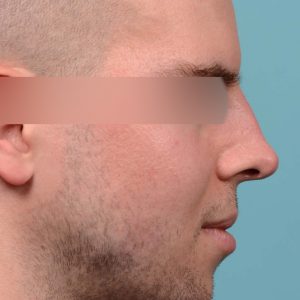 Male rhinoplasty