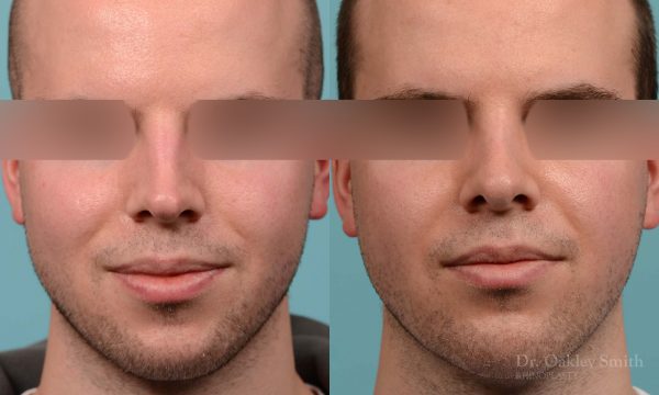 Male rhinoplasty