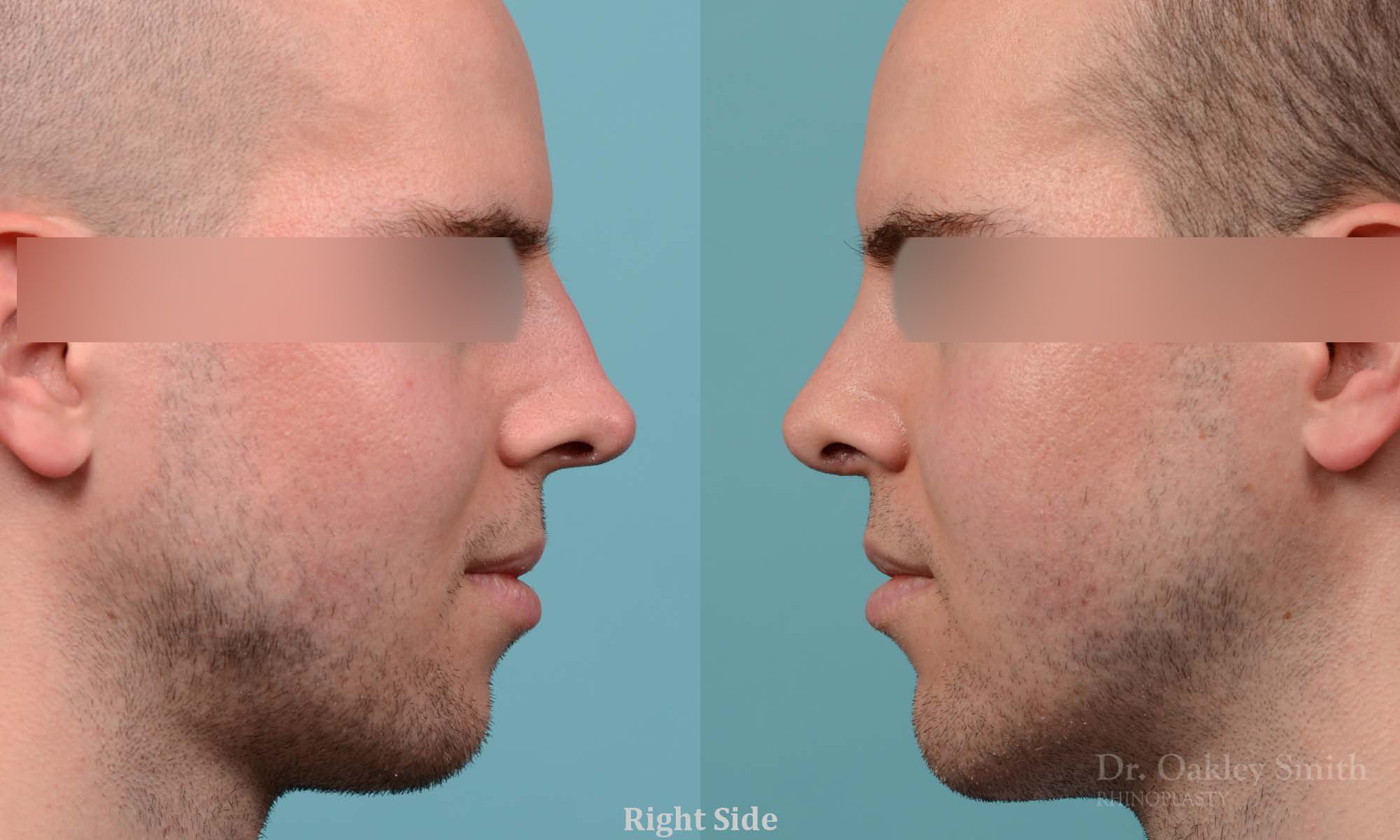 Male rhinoplasty