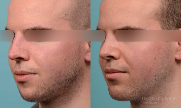 Male rhinoplasty