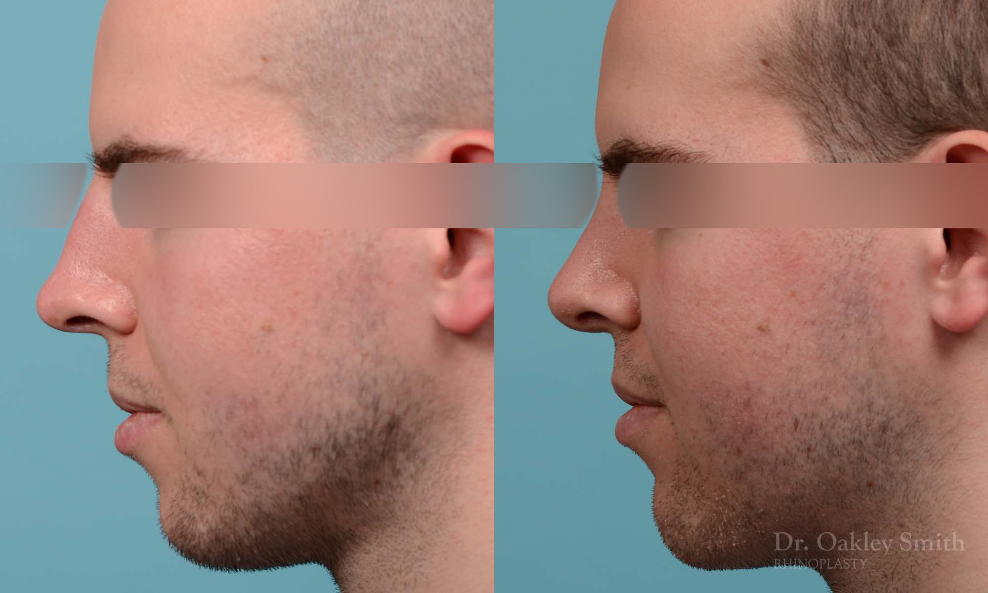 Male rhinoplasty