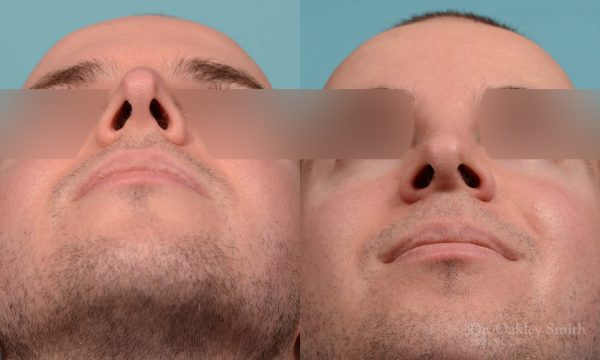 Male rhinoplasty