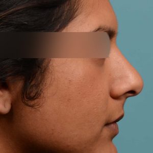 Rhinoplasty nose surgery