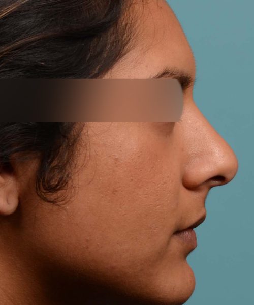 Rhinoplasty nose surgery