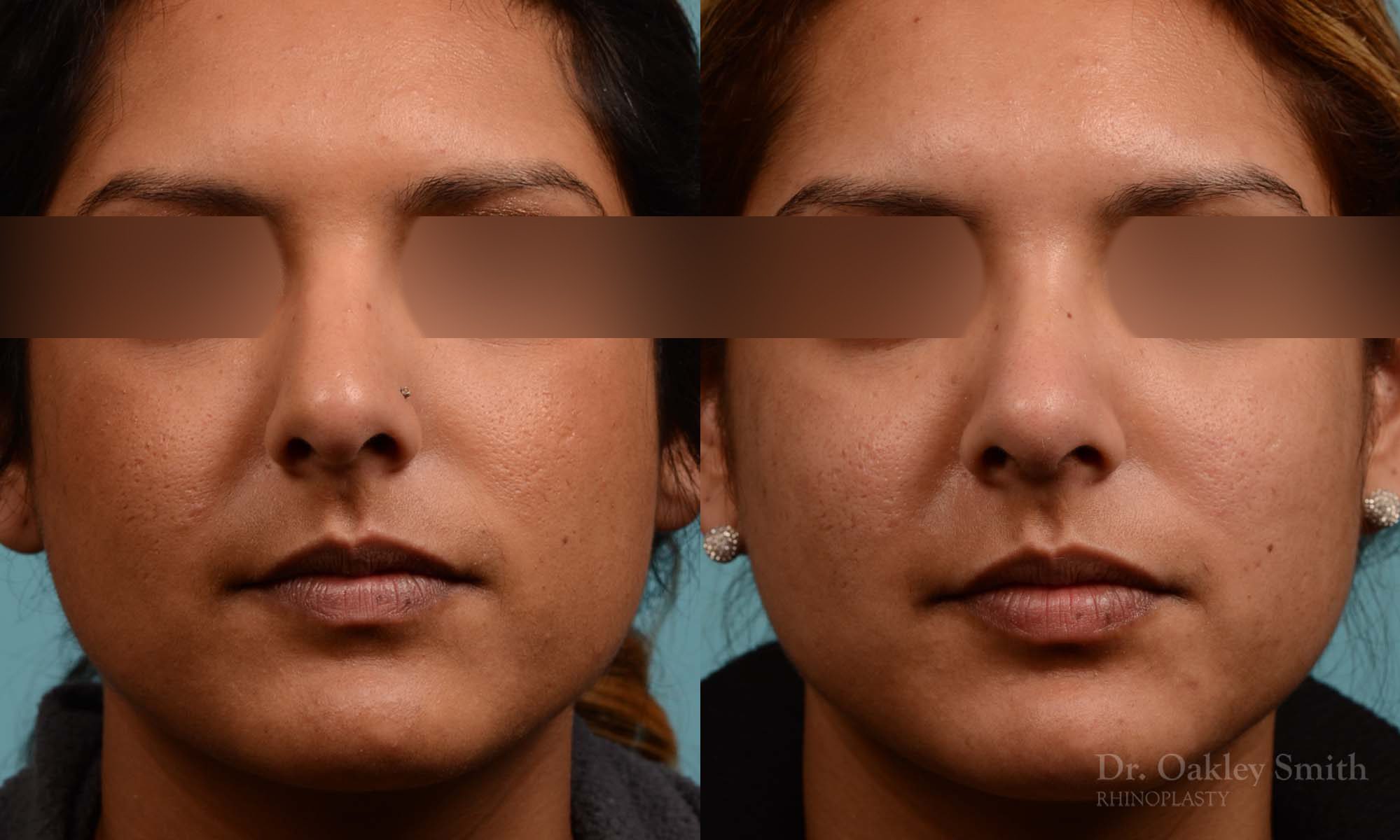 Rhinoplasty nose surgery
