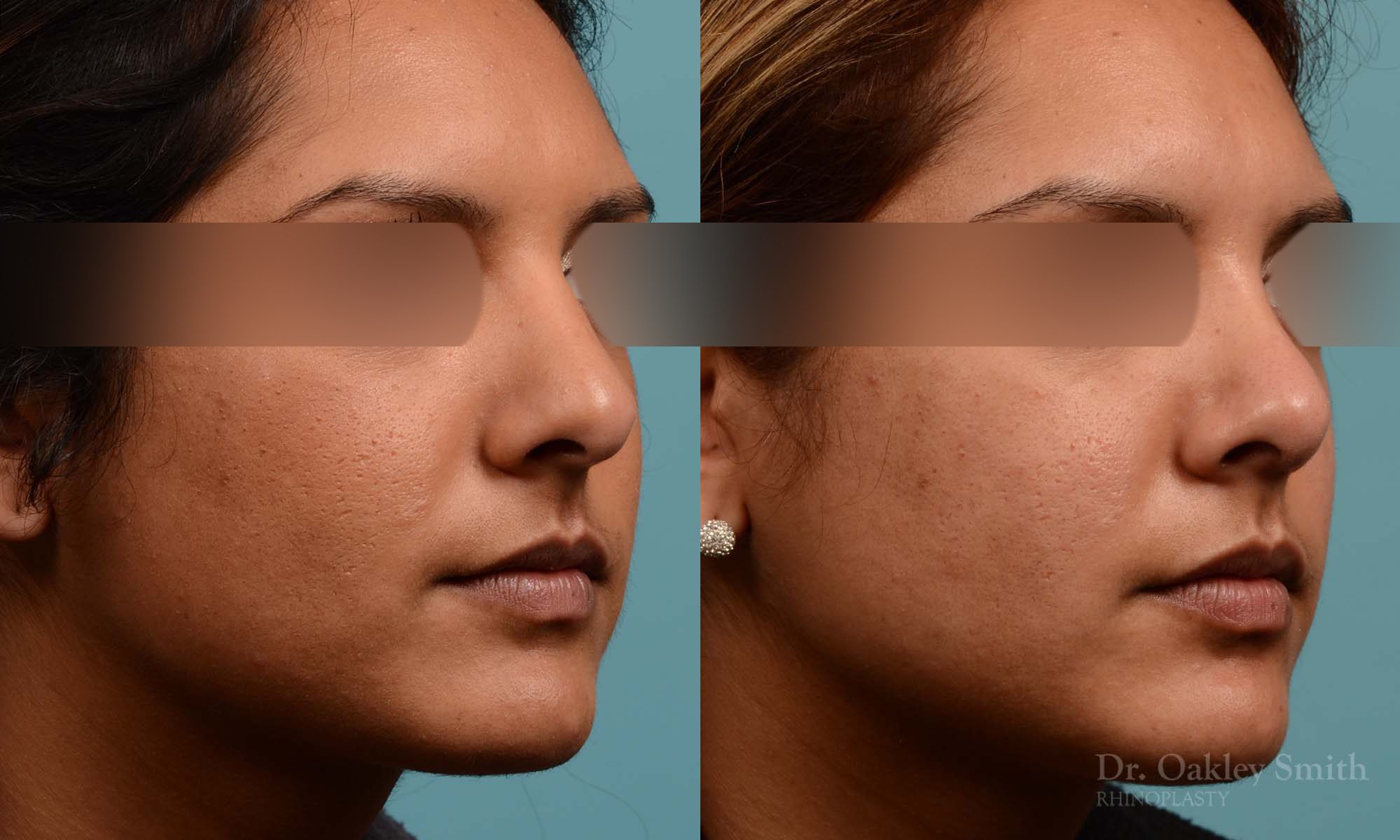 Rhinoplasty nose surgery