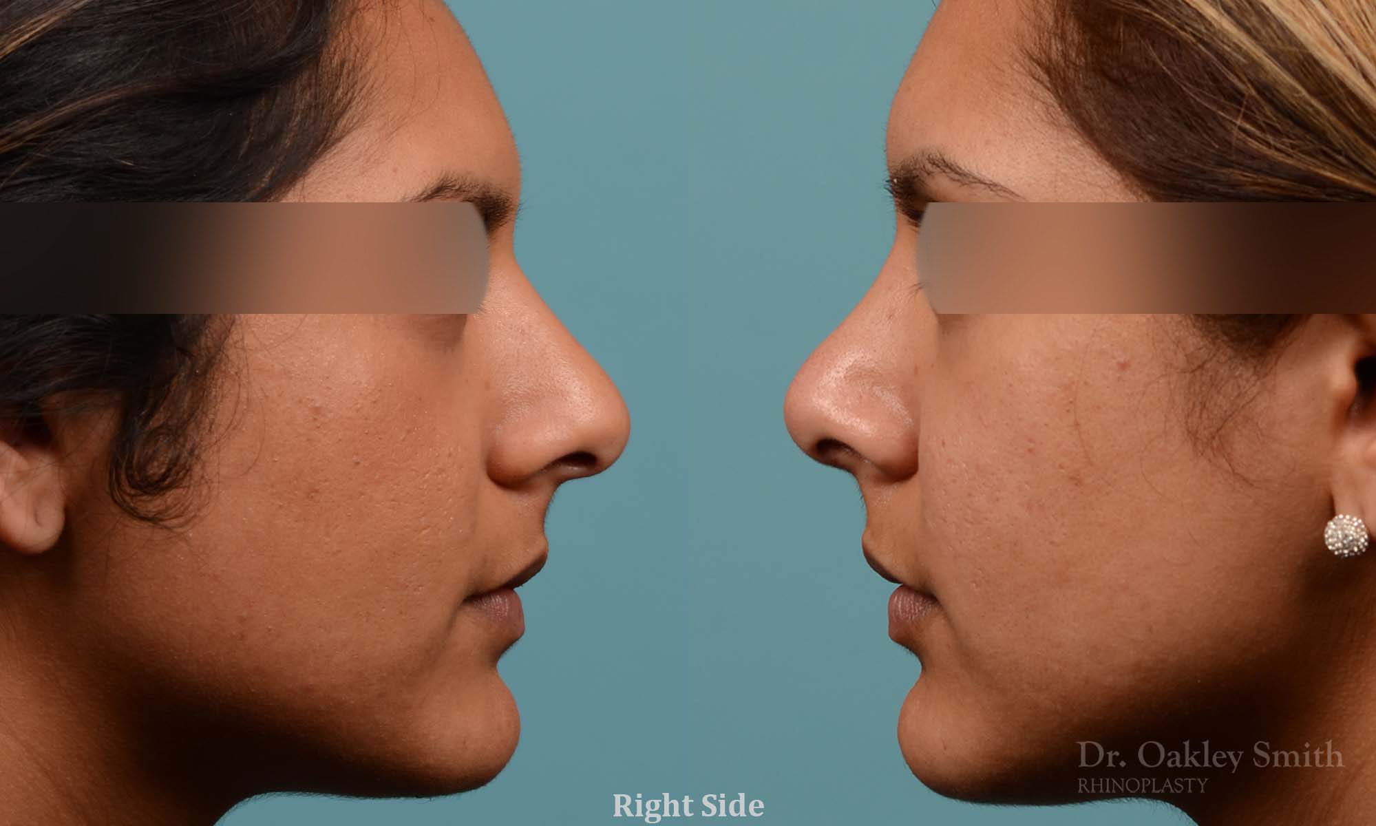 Rhinoplasty nose surgery