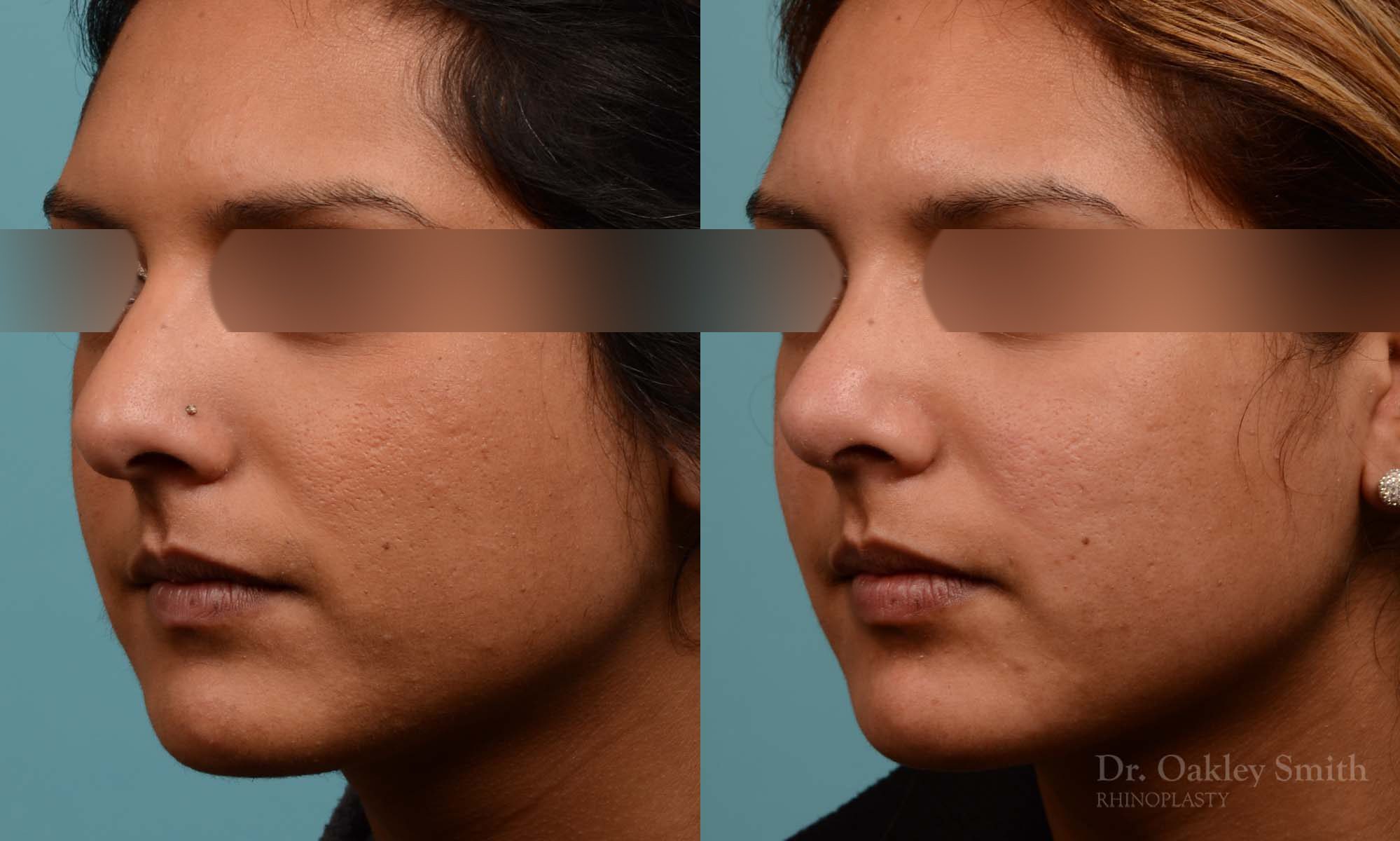 Rhinoplasty nose surgery