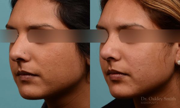 Rhinoplasty nose surgery