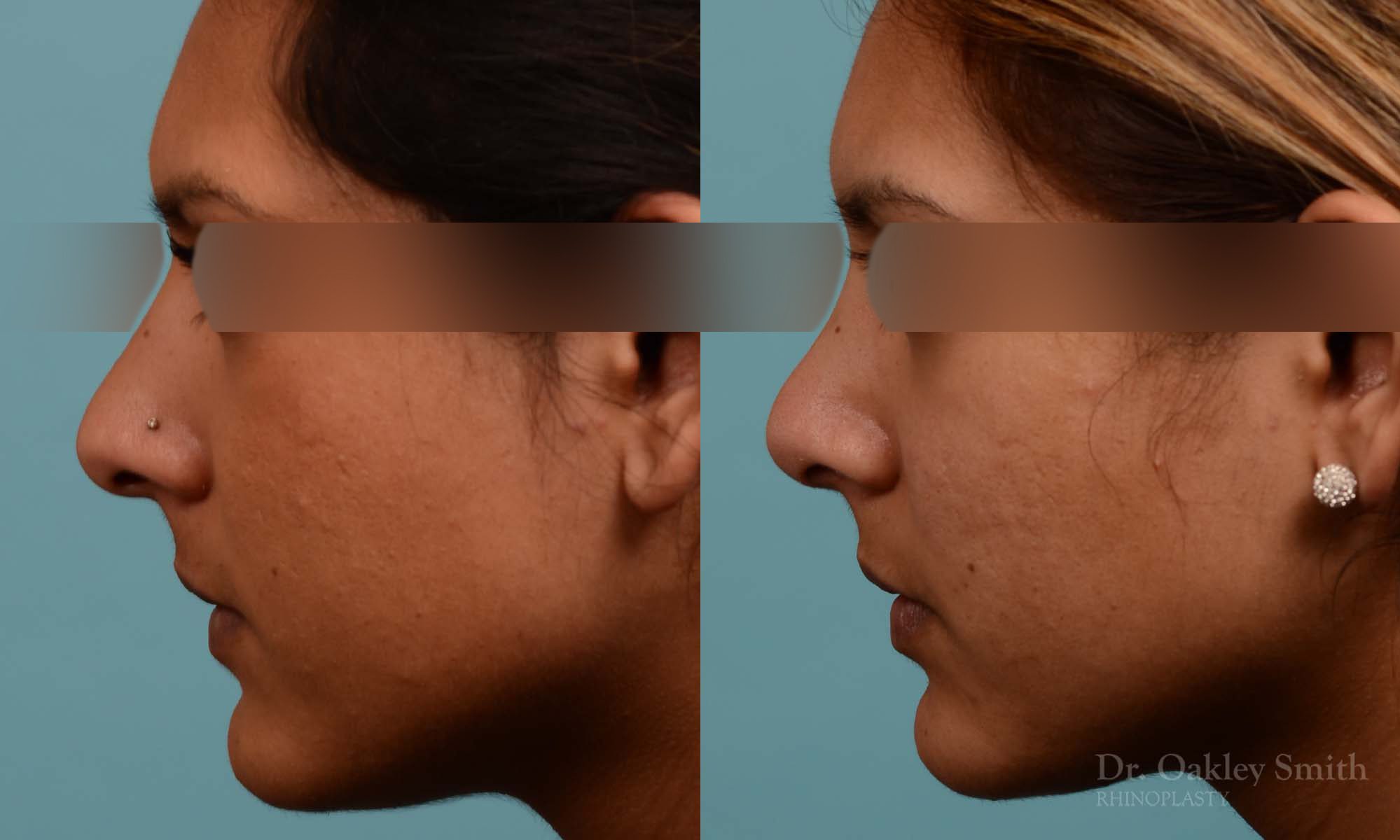 Rhinoplasty nose surgery