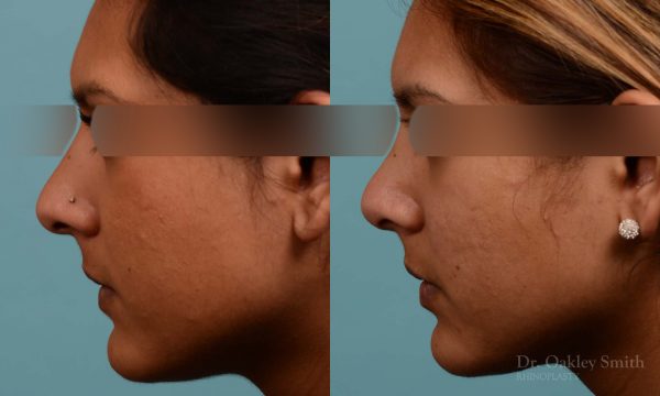 Rhinoplasty nose surgery