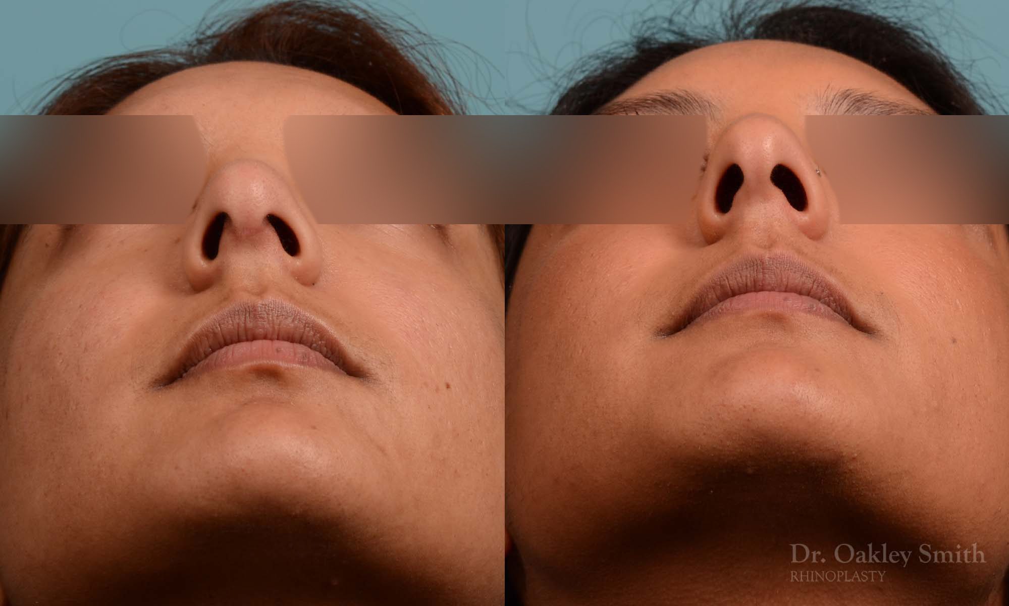Rhinoplasty nose surgery