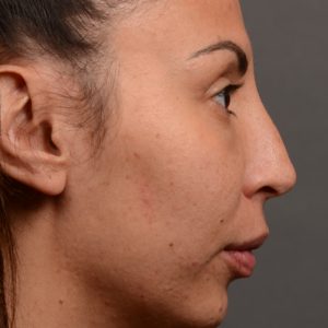 Female rhinoplasty hump reduction