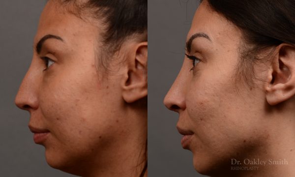 Female rhinoplasty nose surgery to create a more curved nose