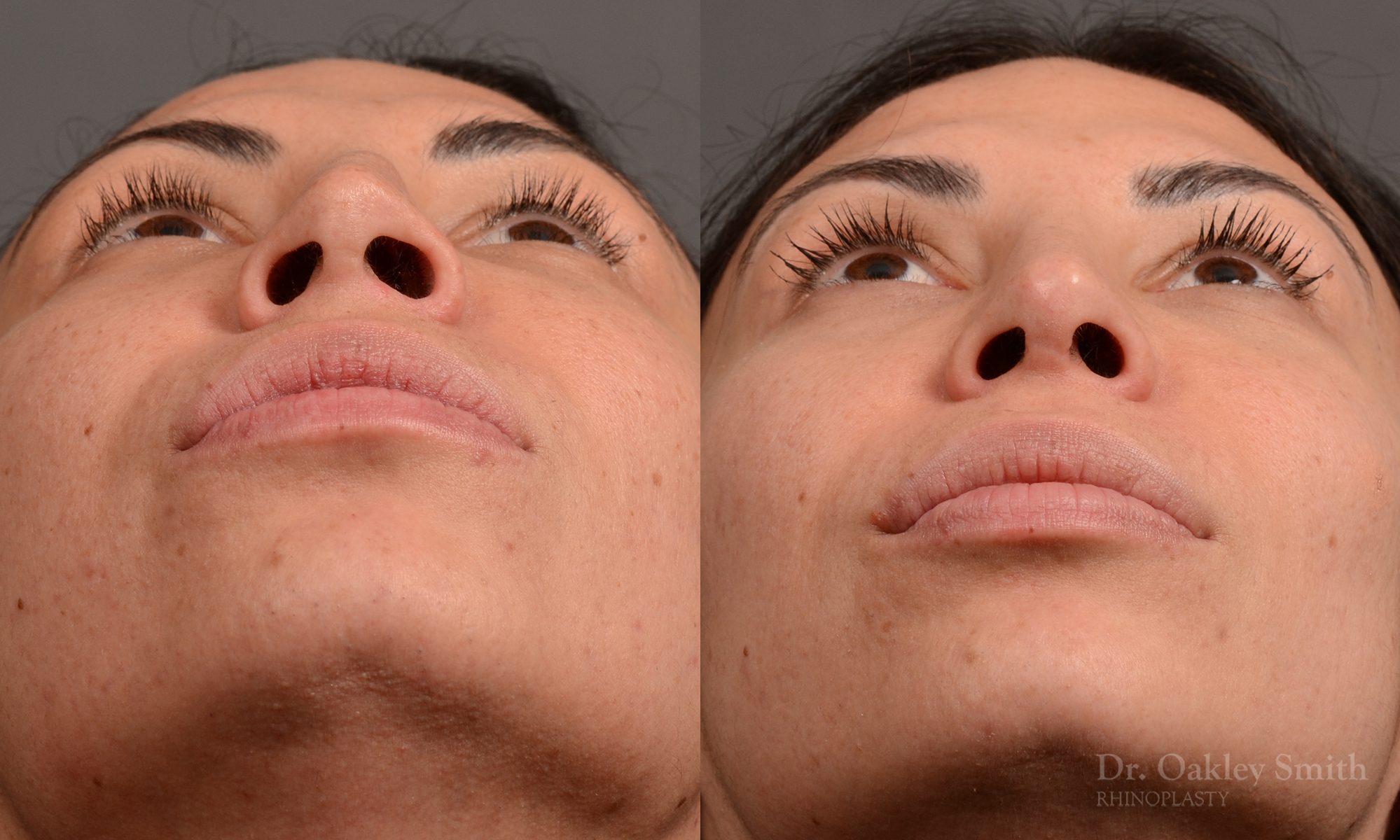 Female rhinoplasty nose surgery to create a more curved nose