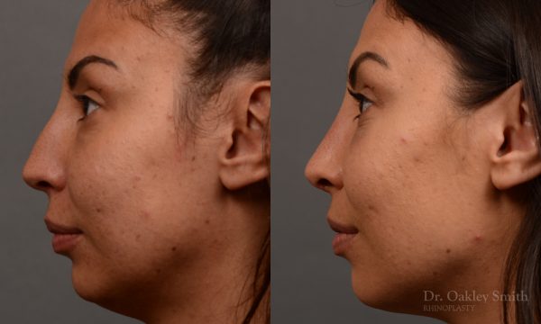 Female rhinoplasty hump reduction